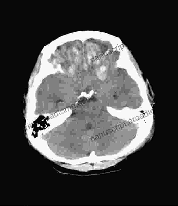 CT Scan Of Traumatic Brain Injury Showing Contusions And Bleeding In The Brain Underwater: When Encephalitis Brain Injury And Epilepsy Change Everything