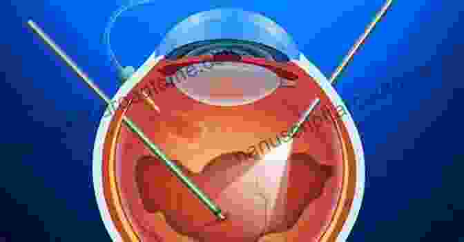 Diagram Of A Vitrectomy Procedure Macular Hole Surgery And The Importance Of The Face Down Positioning : A Guide For Patients Undergoing Vitrectomy