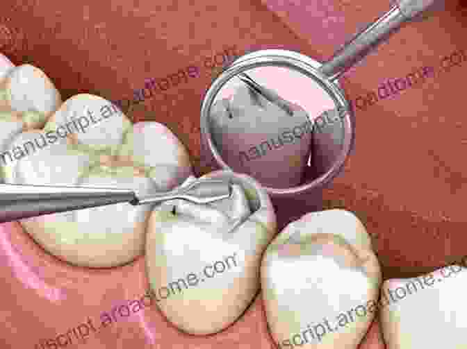 Tooth With A Cavity Filling, Depicting The Need For Cavity Prevention Stop Tooth Decay : How To Prevent Cavities For Life (Holistic Practitioner S Guide Series)